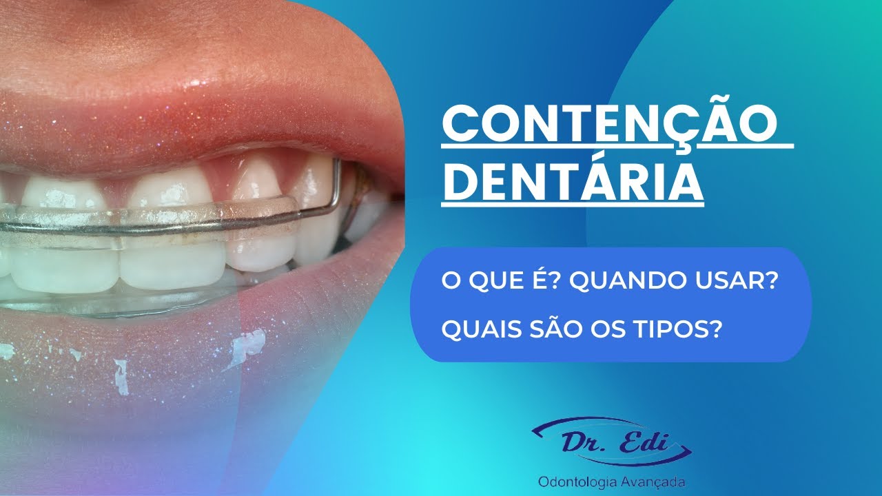 Contenção Com Dente | Contenções Dentárias: Importância e Tipos – QKFR