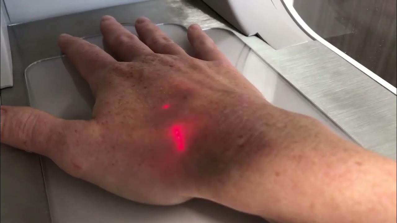 Fractional CO2 Laser Hand Resurfacing Hand Rejuvenation Treatment in