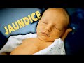 NEWBORN WITH JAUNDICE! (Why Parents Can't Miss This) | Dr. Paul