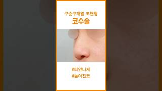 구순구개열로 코변형이 되신 분이라면