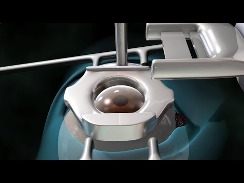 Vídeo: 3 maneres de saber si la cirurgia ocular de Lasik és per a vosaltres