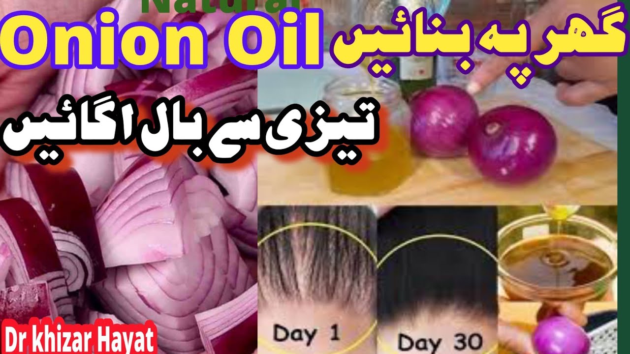 Onion Oil for extreme Hair Growth.Stop Hair loss.