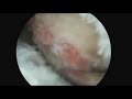 Endoscopic Hamstring Repair and Ischial Bursectomy