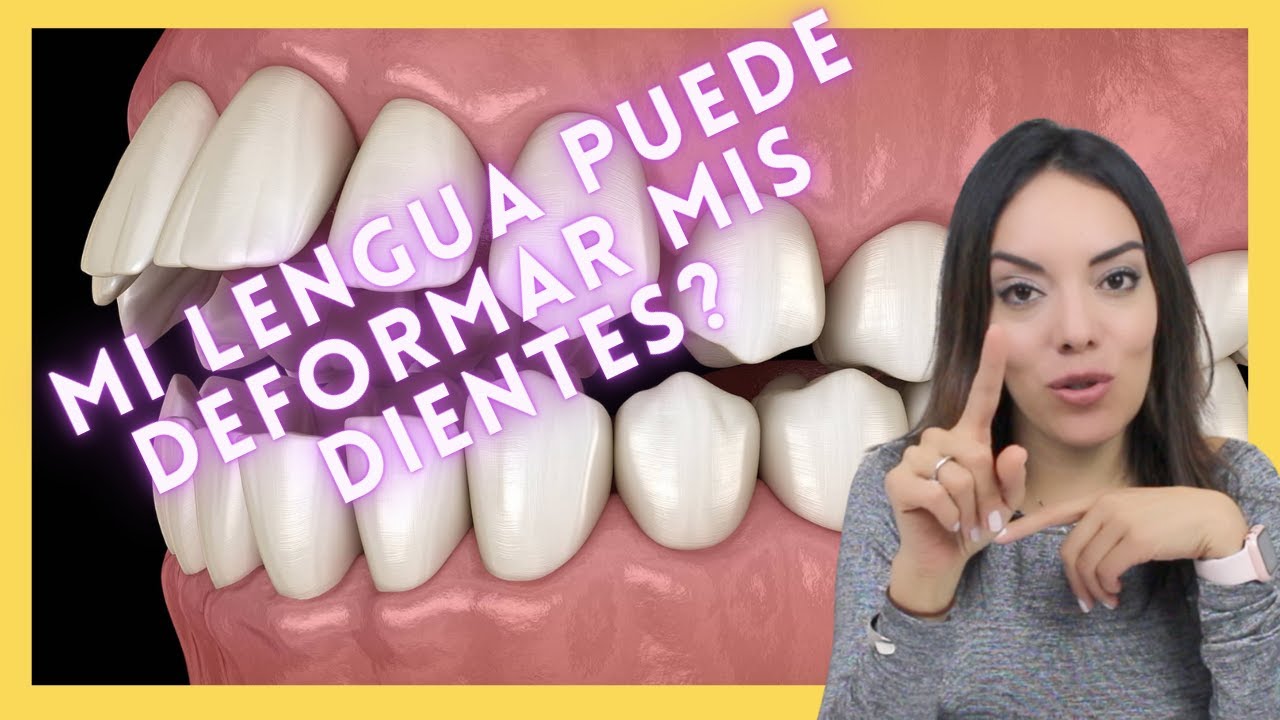 Hábito de Lengua y como evitar DEFORMACIONES