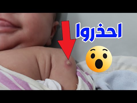 فيديو: هل كان لقاح شلل الأطفال إلزامياً عندما ظهر لأول مرة؟