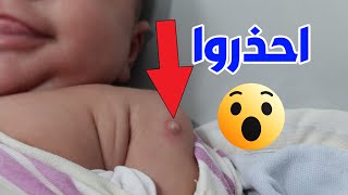 احذري من الاقتراب من هذه الندبة  🚫❌ خطر علي الطفل