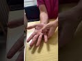 Trigger finger Transverse Friction