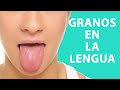¿CÓMO CURAR los GRANOS en la LENGUA?