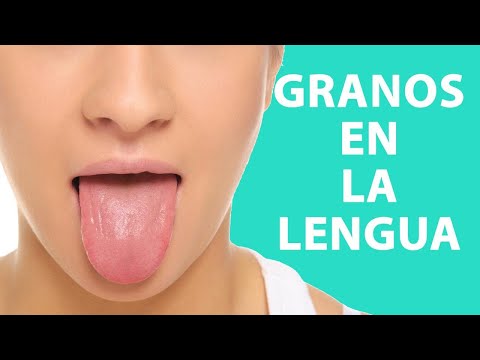 Video: 3 formas sencillas de curar la lengua después de comer dulces agrios