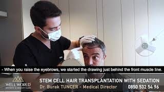 Stem Cell Hair Transplantation With Sedation Well World Aesthetic Longevity Clinic