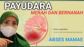 ABSES PAYUDARA - PENANGANAN DAN GEJALA  ABSES MAMAE