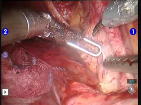 Robotic-assisted Total Laparoscopic Hysterectomy And Lymph Node Dissection