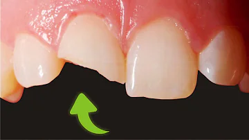 ¿Puede repararse un diente agrietado?