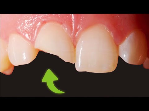 RECONSTRUCTION of front tooth - fractured tooth