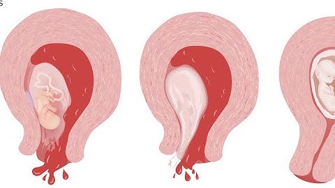 Understanding abortion (basic principles - definitions, types, investigations, management) 