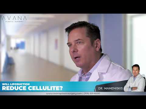 Will liposuction reduce cellulite? - Dr. Mameniskis