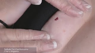 Cherry Angioma - Skin Rejuvenation treatment with Dermalase IPL