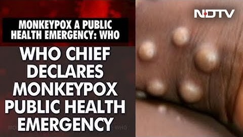 Monkeypox Declared Global Health Emergency By WHO Amid Rising Cases