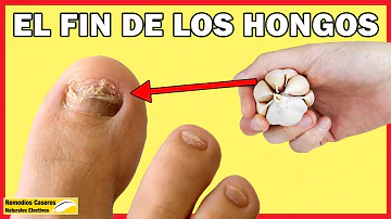 ¿Cuánto tarda el ajo en curar los hongos en las uñas de los pies?