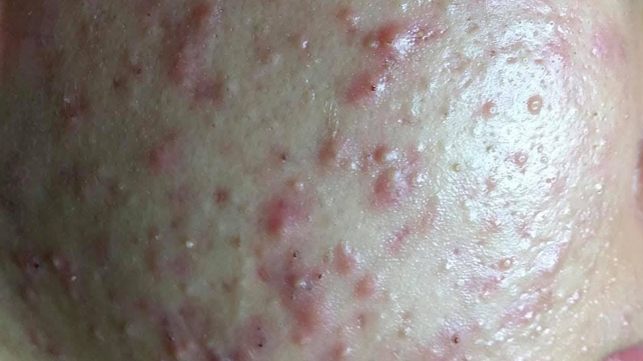AWESOME BLACKHEADS, WHITEHEADS and ACNE EXTRACTION #461
