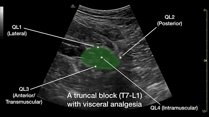 The Anterior Quadratus Lumborum (QL) Block