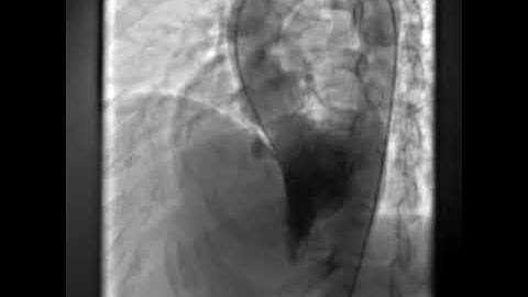LV Angiogram profiling Perimembranous VSD prior to closure with a symmetrical PMVSDO