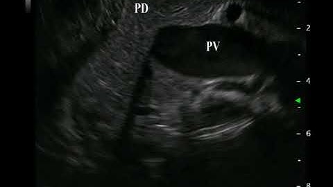 Video 9 Scanning Pancreatic Duct, Common Bile Duct and Ampulla from the Stomach