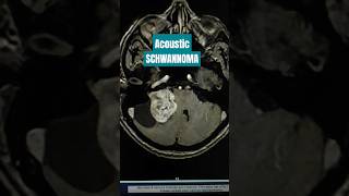 Acoustic Schwannoma #shorts #shortsvideo #viral Acoustic Schwannoma #shorts #shortsvideo #viral