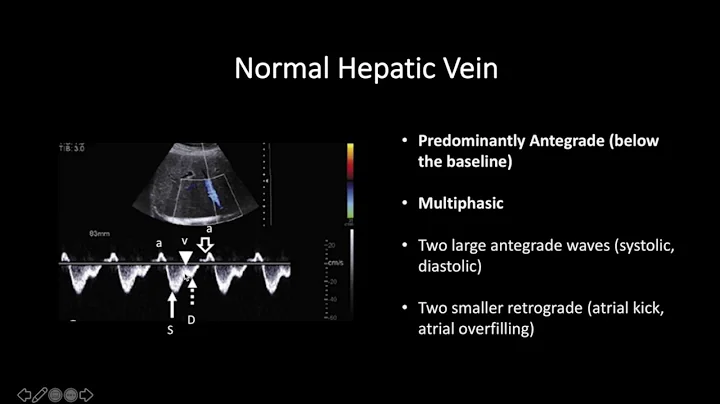 Doppler Ultrasound Part 2 - Spectral Waveforms from Head to Toe (Normal and Abnormal)