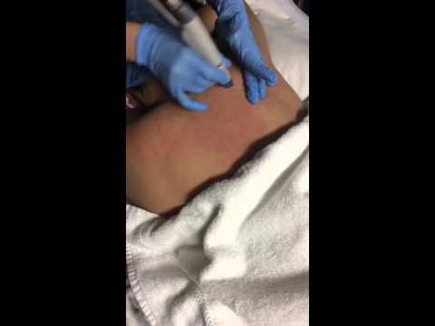 Hydrafacial MD treatment for back acne