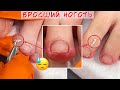 Вросший ноготь на маленьком пальце ноги 🦶 Что делать?