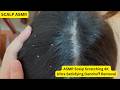 ASMR SCALP SCRATCHING , ULTRA STATISFYING DANDRUFF REMOVAL #47 @OzleyASMR