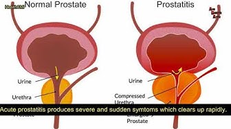 homeopátia prostatitis vélemények