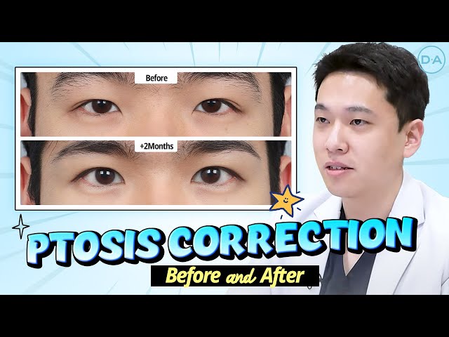 Plastic Surgery Korea] Ptosis Correction Before & After - YouTube