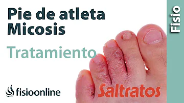 ¿Pueden enfermar los hongos de los dedos de los pies?