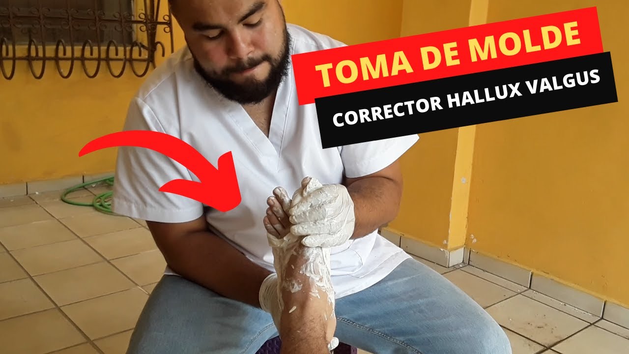 Toma de molde corrector de hallux valgus - YouTube