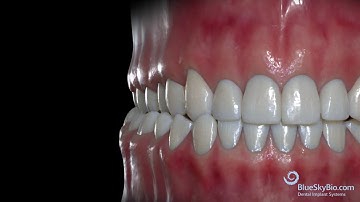 Unilateral Crossbite: Functional Shift