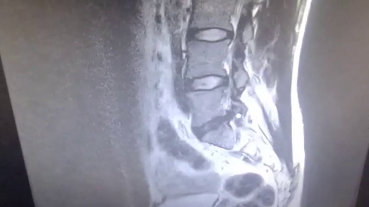 اشعة الرنين المغناطيسي 3D صور متحركة اصعب مرحله في حياتي