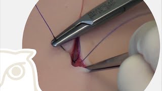 CSL: subcutaneous suture