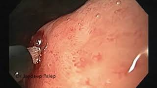 Download Lagu Upper GI bleed Dr. Palep MP3