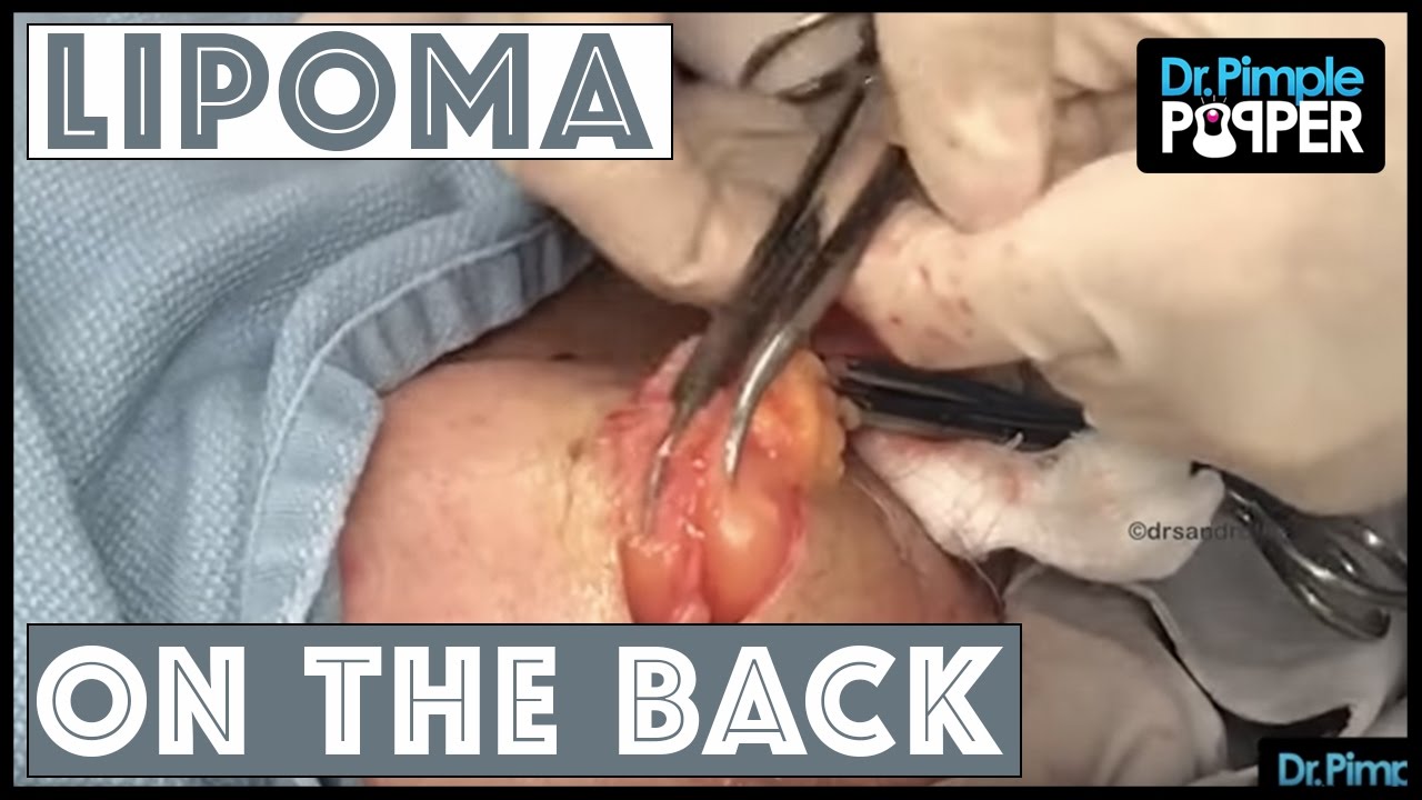 Jiggle that Lipoma, just a little bit - Published on Feb 27, 2017