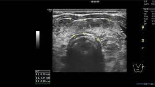 Клинический случай 4. (УЗИ Щитовидной Железы ) доктор А.В. Ушаков