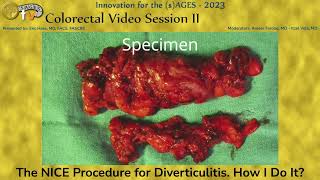 The NICE Procedure for Diverticulitis. How I Do It?