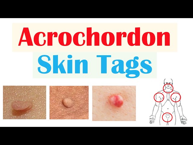 Skin Tags (Acrochordons)  Causes, Risk Factors, Symptoms