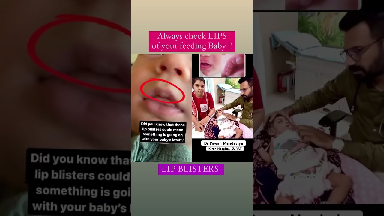 LIP blisters in Newborn Baby. #tonguetie #newbornbaby #pediatriciantips #shorts @drpawanmandaviya