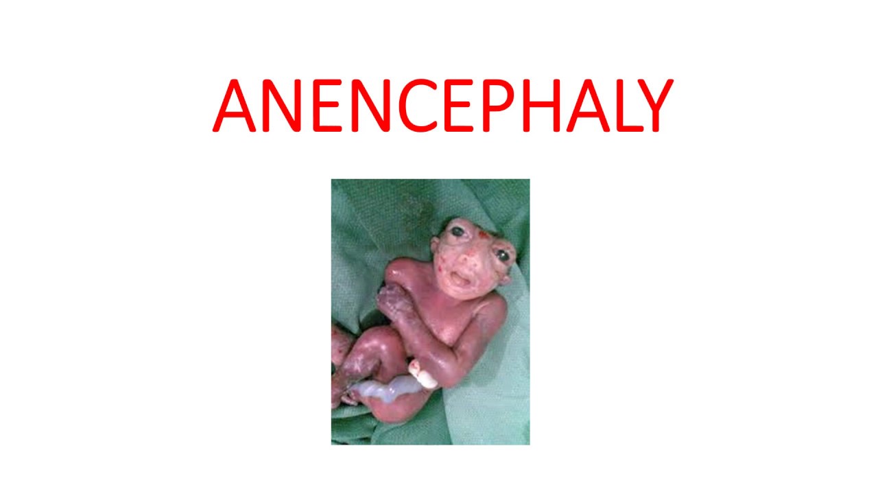 Meaning anencephaly Anencephaly: Definition,