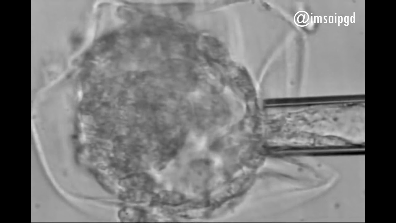 Trophectoderm biopsy (Day 5 - Embryo Biopsy) - YouTube