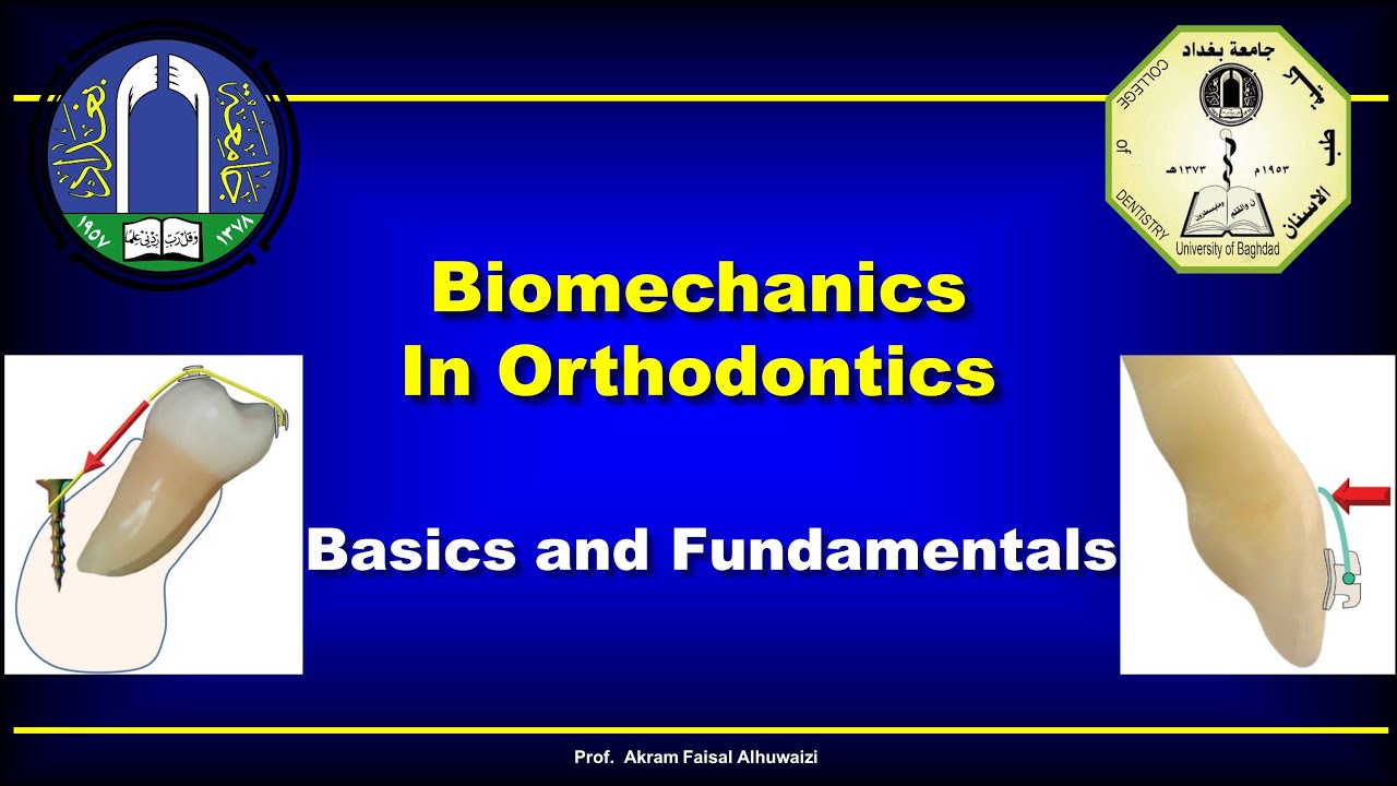 Overlay wires - Biomechanical Institute for Orthodontics