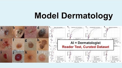 Artificial Intelligence in Dermatology - Model Dermatology