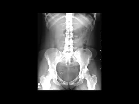Introduction To The Abdominal Kub In The Er Setting Youtube